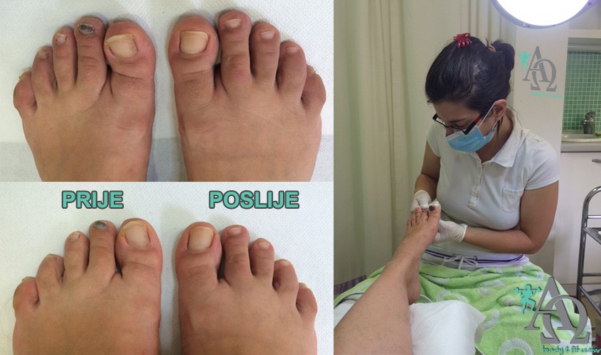 medicinska pedikura